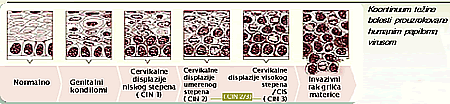 Koontinuum teine bolesti prouzrokovane humanim papiloma virusom